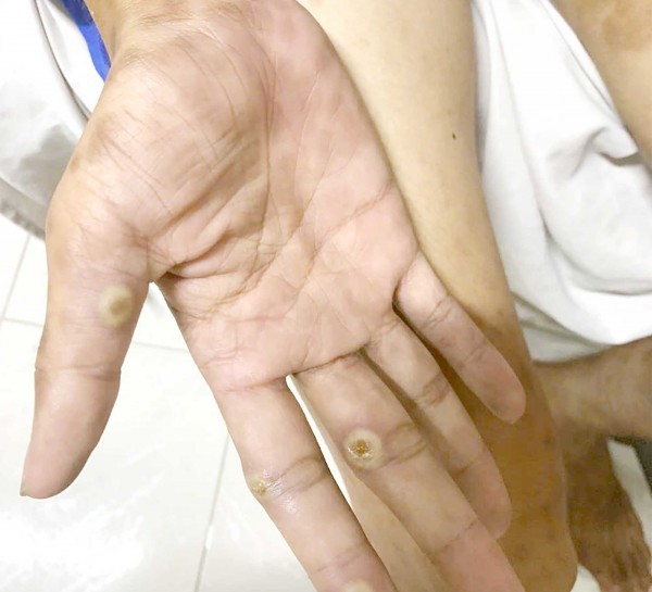 Đồng Nai: Siết chặt kiểm soát, truy vết nguồn lây nhằm hạn chế bệnh đậu mùa khỉ lây lan